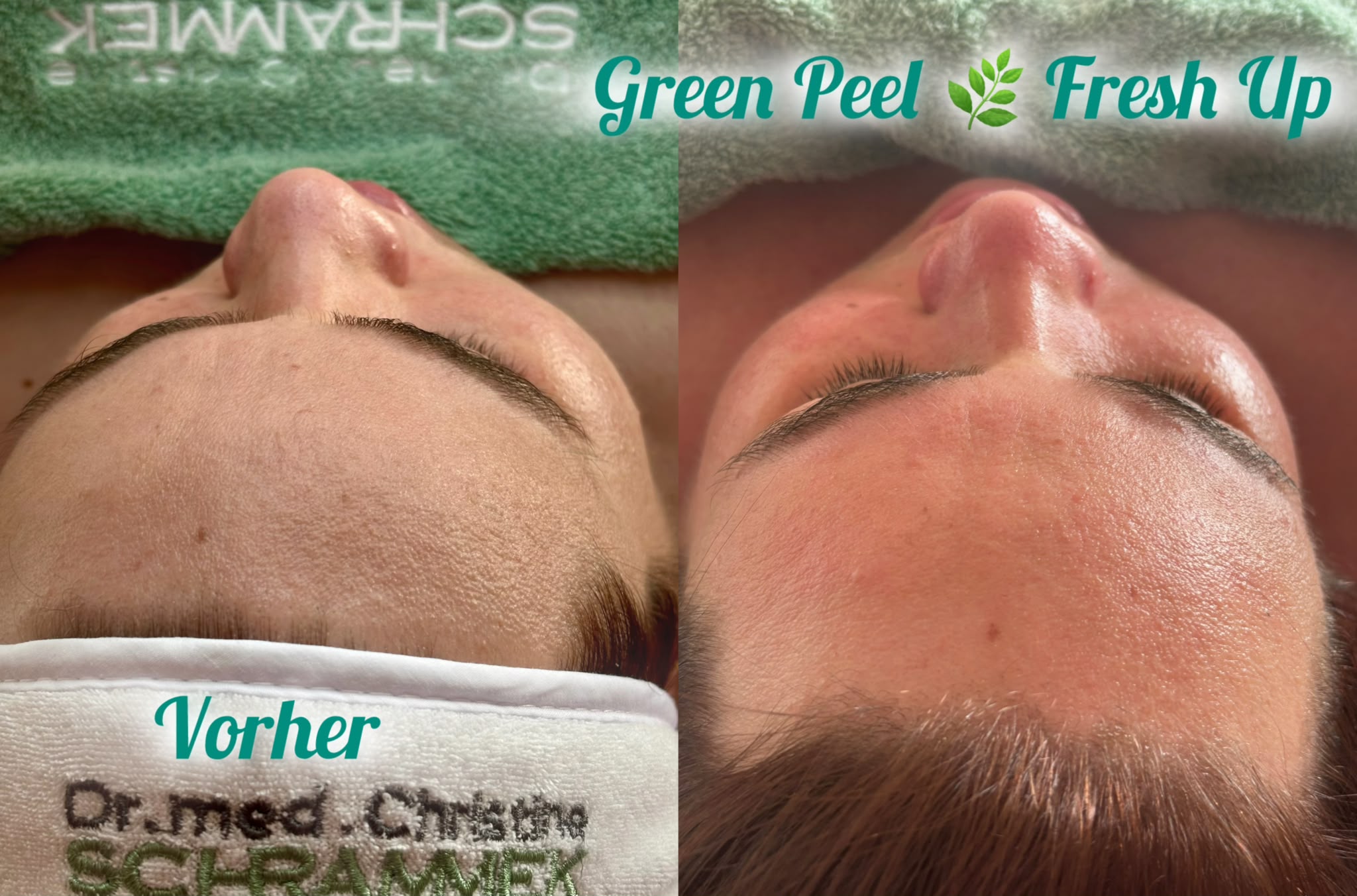 Green Peel Fresh Up Behandlung